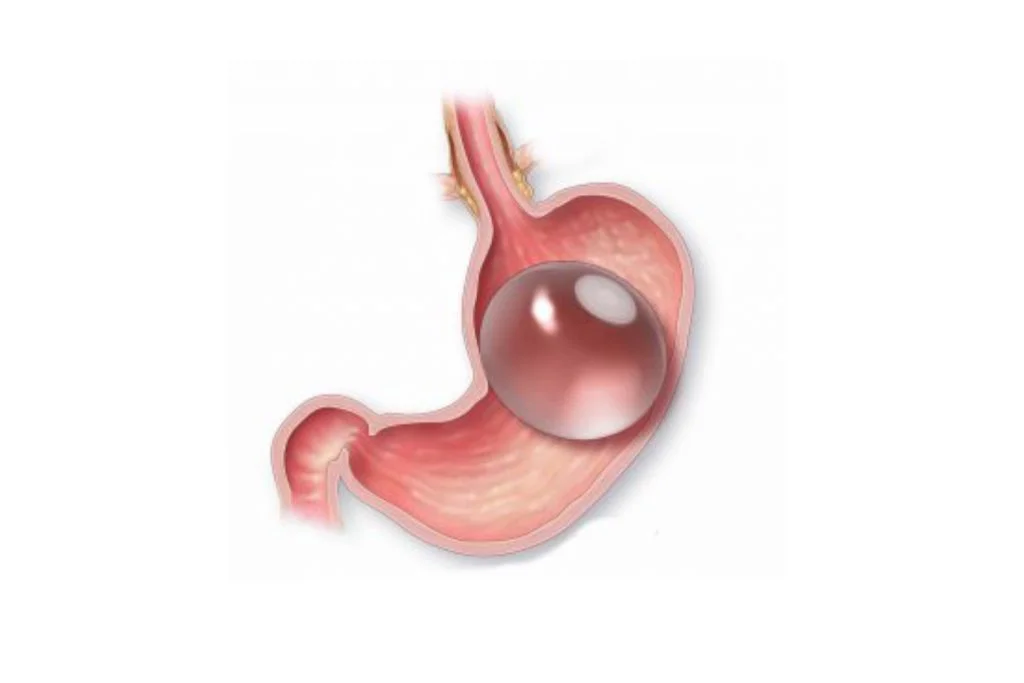 Gastric Balloon Procedure Anatomy