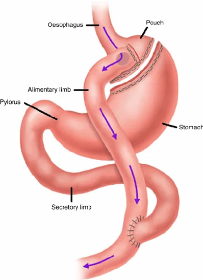 Gastric Bypass Surgery Anatomy