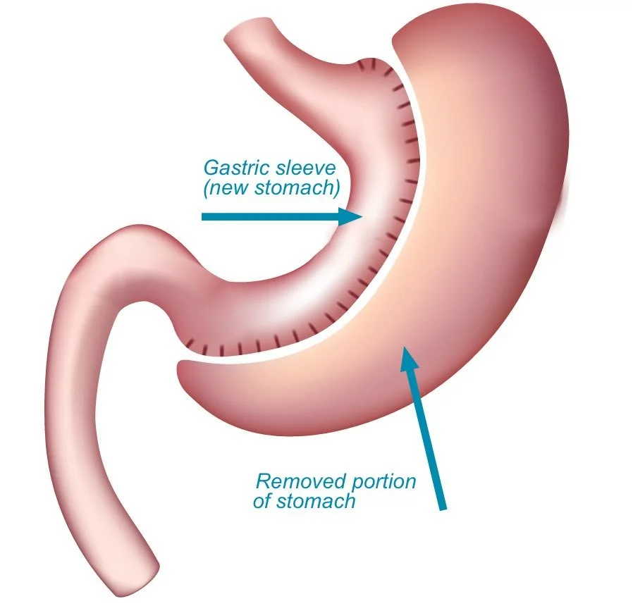 Gastric Sleeve Surgery Anatomy