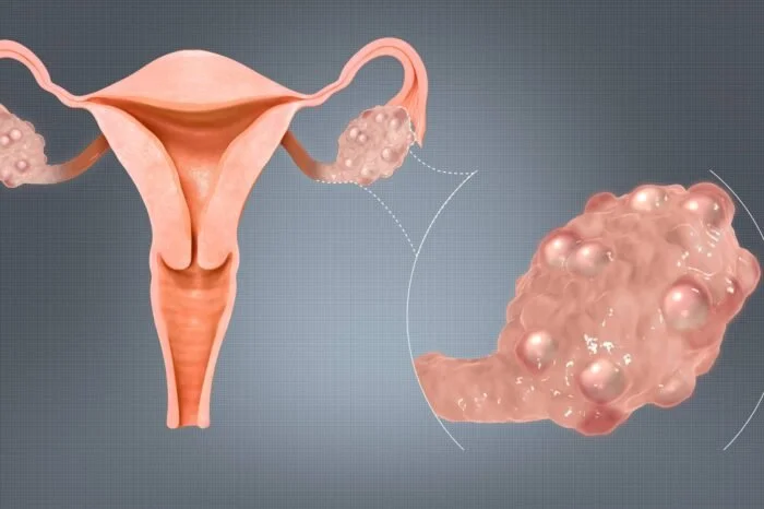 Obesity and PCOS | Balance Hormones & Improve Fertility