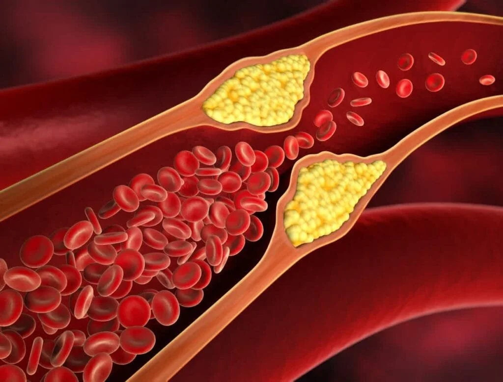 Obesity and High Cholesterol