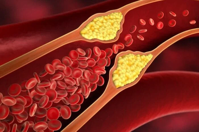 Obesity and High Cholesterol
