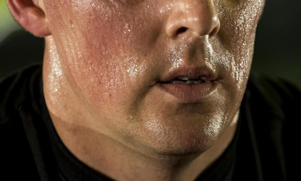 Obesity and Excess sweating