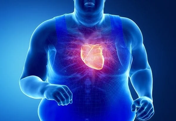 Obesity and Heart disease