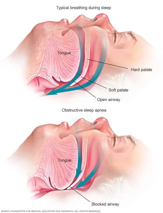 Obesity and Obstructive Sleep Apnea