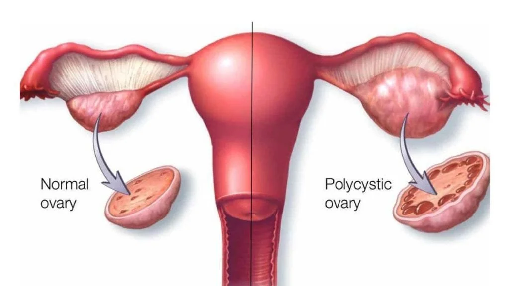 Obesity and Polycystic Ovary Syndrome (PCOS).
