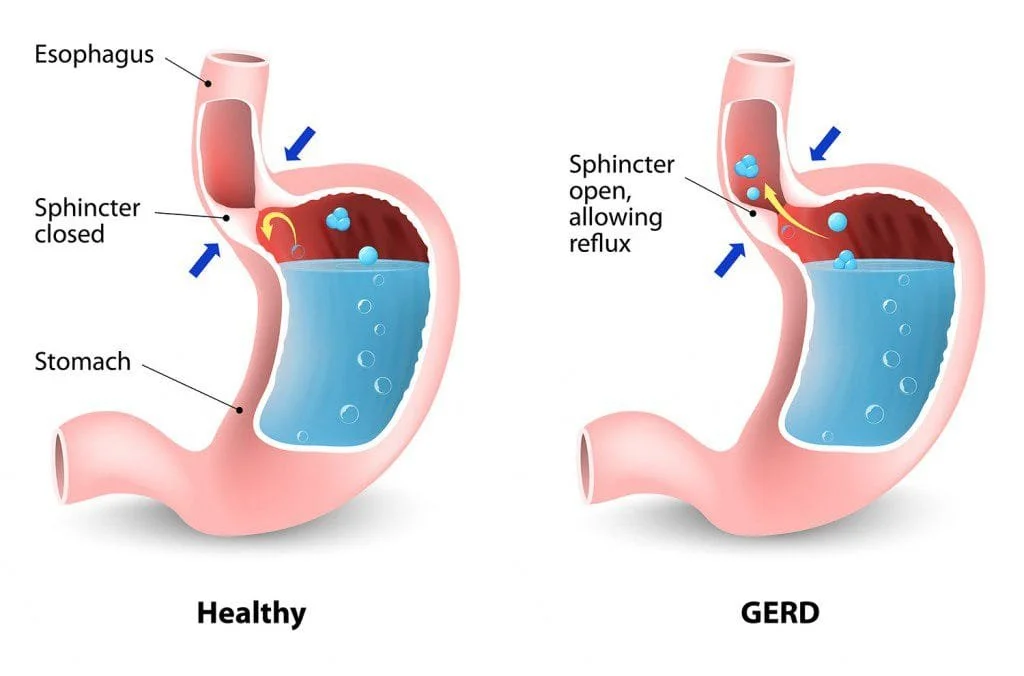 Obesity and Gastroesophageal Reflux Disease
