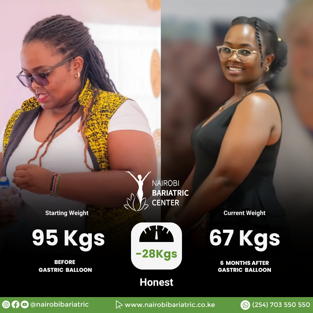 Honest Before and After Weight Loss