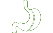 gastric sleeve