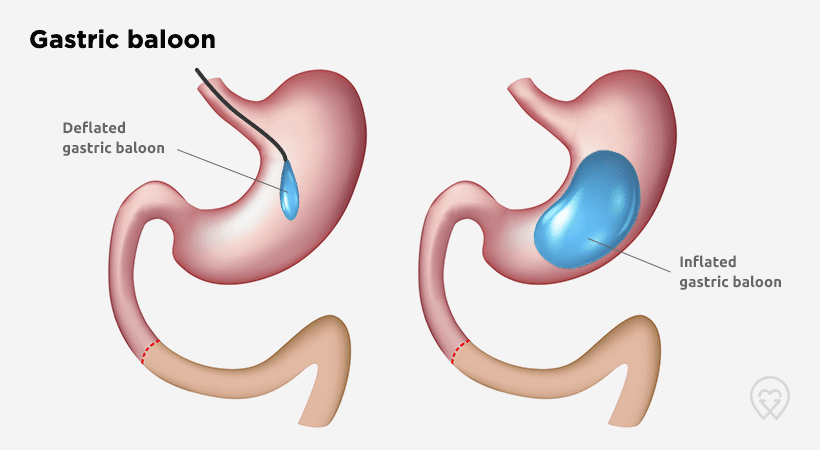 nairobi-bariatric-center-gastric-balloon-kenya