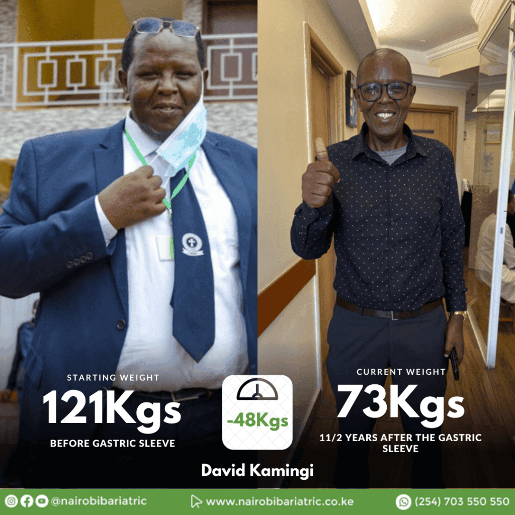 David_Kimingi_gastric_bypass_before_after