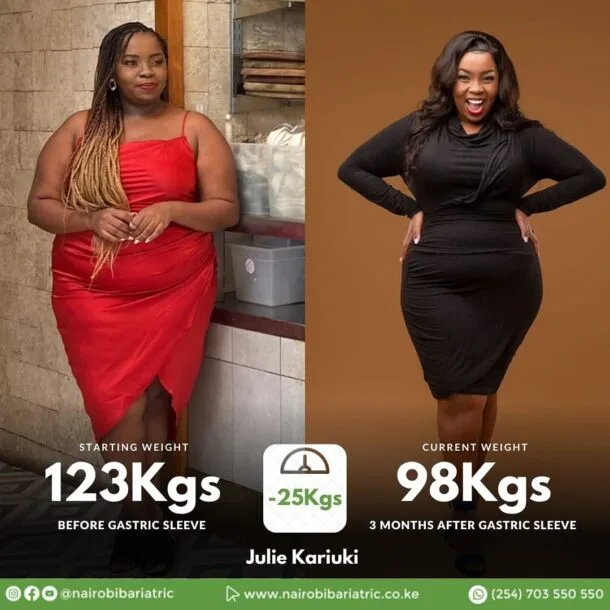 Julie Kariuki before/after photo after gastric sleeve surgery at Nairobi Bariatric Center